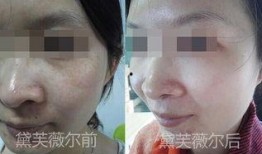 生活每日爆料之去斑视频,去斑视频大揭秘，告别斑点困扰